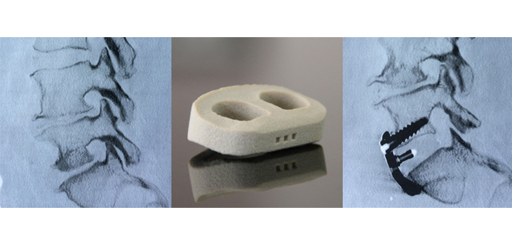 First 3-D Printed Spine Cage Implanted