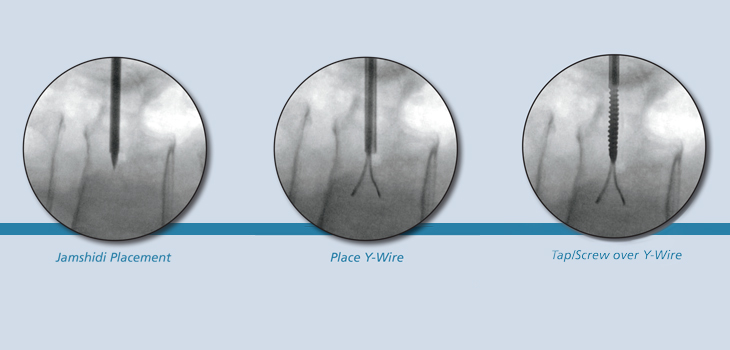 SafeWire Receives 510(k) Clearance for Y-Wire 2