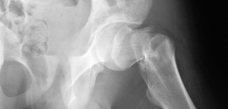 Fractures Hotbed of Infection? Yes! New Study From Sweden