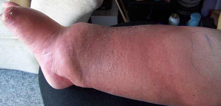 New Study: Infection Risk 7x Greater With Diabetes