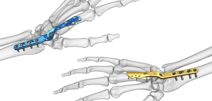 Acumed: New Wrist Plating System for Arthritis
