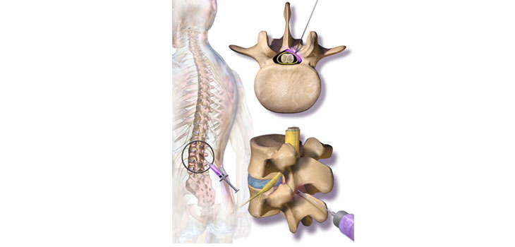 Steroid Injections for Spinal Stenosis Fail Test
