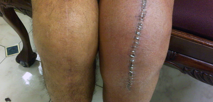 Partial Knee Replacement Safer Than Total Knee