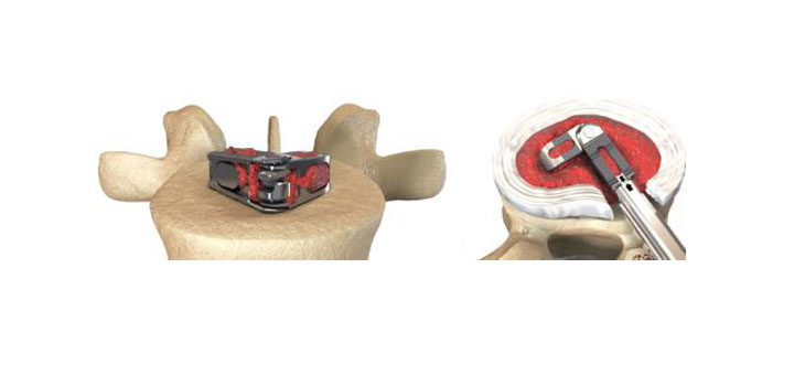 Expanding Orthopedics: U.S. Clearance for FLXfit