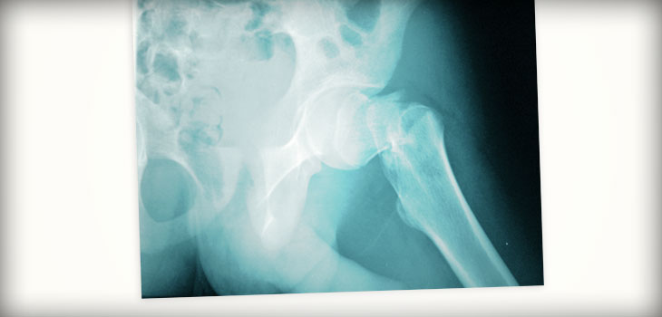 Oxidative Stress Predicts Hip Fracture