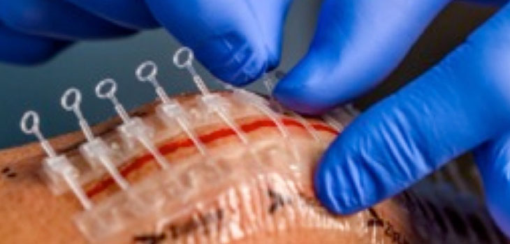 Zippers Instead of Sutures? This is Cool.