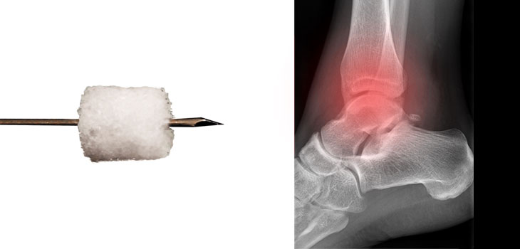OsteoSponge Improves Ankle Pain and Disability in Study