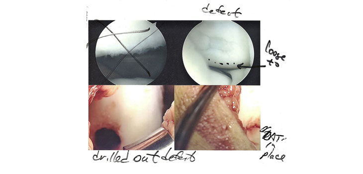 New Treatment for Torn Meniscus
