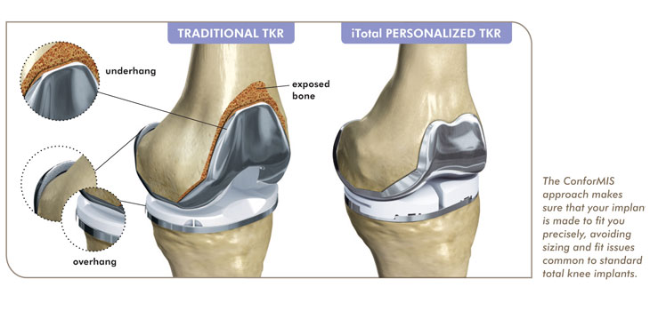 ConforMIS’ iTotal Trumps Off-the-Shelf Competitors