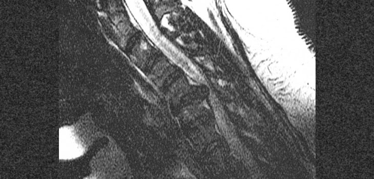 LDR Applauds UHC Cervical Disc Coverage