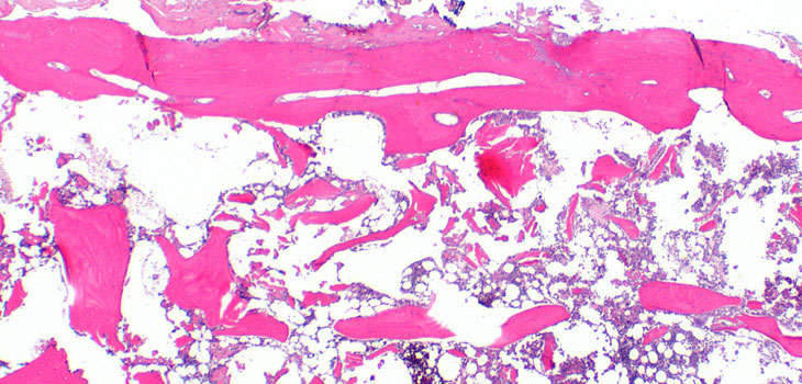 UK Scientists: Metabolic Disease Key to OA?