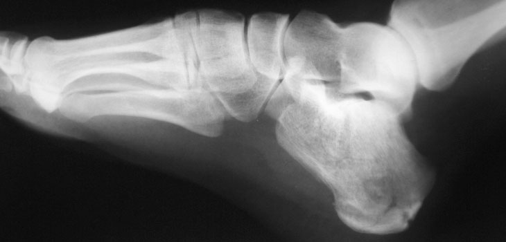 Surgery Ineffective For Heel Fractures