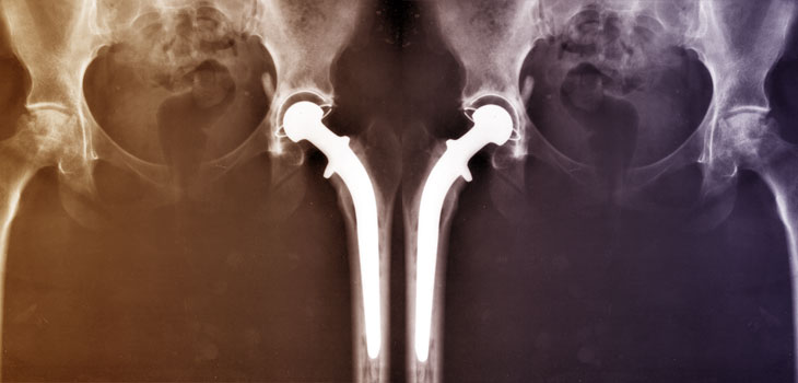 Biomet UK Withdraws Flawed Hip Shell