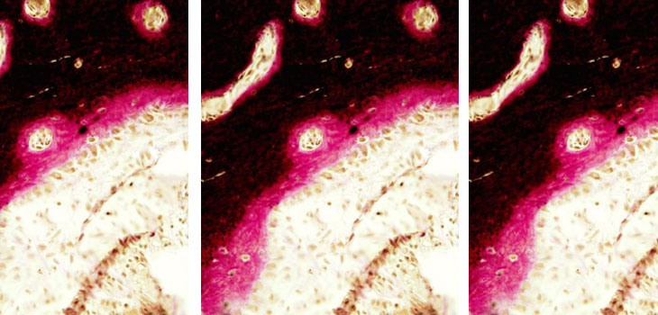 Genetic Bone Disease Gets Boost With Novel Treatment