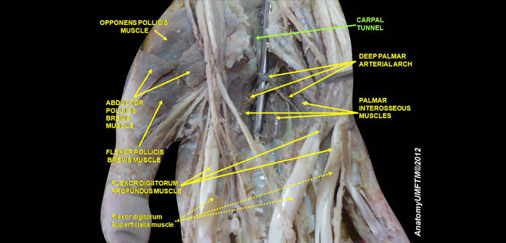 Carpal Tunnel Syndrome and Hypothyroidism