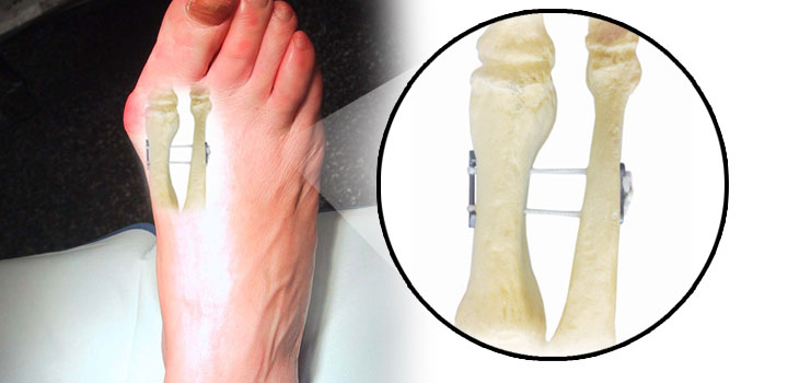 Arthrosurface Self-Cinching Suture Cleared by FDA