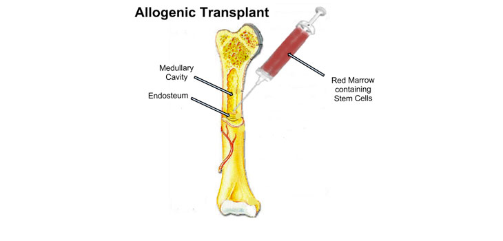 Stem Cells for Shoulder Repair