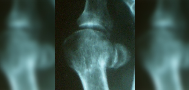 OA Clue Found in Alteration of Cell Behavior