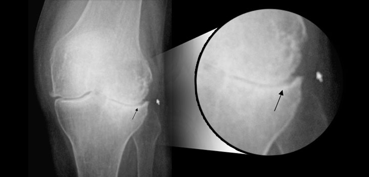 Study: Skip Surgery for Knee OA