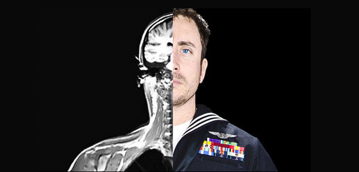 Concussion May Be Hidden Neck Injury