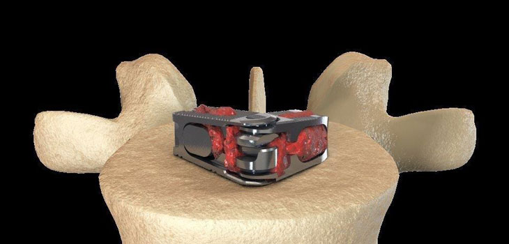 Expanding Orthopedics: First Ever Surgery With FLXfit