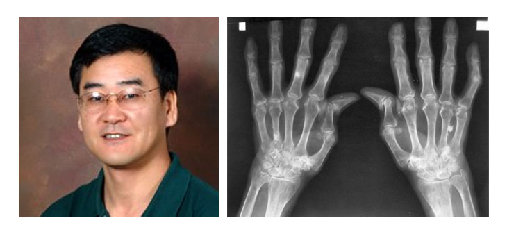 Protein Protects Against Arthritis-Related Bone Loss