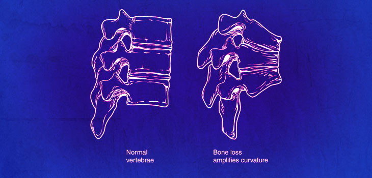 Bone-Forming Agent Shows Promise