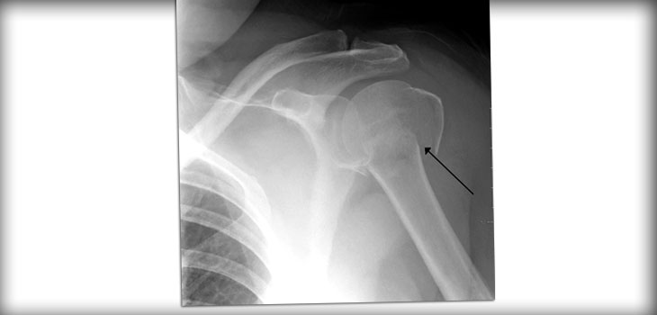 Which Tommy John Techniques Are Best? (trick question) // Surprising Study: 3D Imaging Only Slightly Better Than 2D // and More!