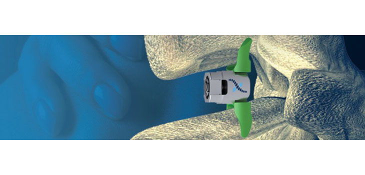 FDA Ortho Panel to Review VertiFlex Spine Device