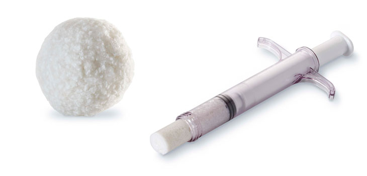 Biostructures’ Bone Graft Trumps Autograft for Fusion