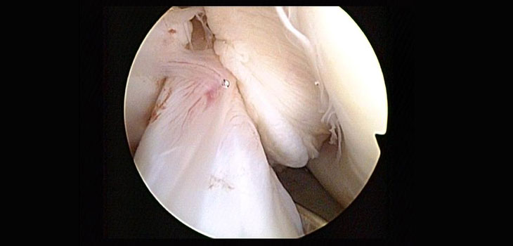 Torn ACL: Hit the OR or Play it Safe?