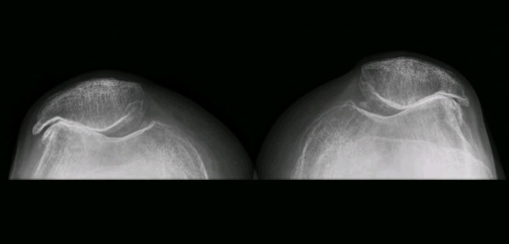 UK Researchers Use Microphones to Detect OA