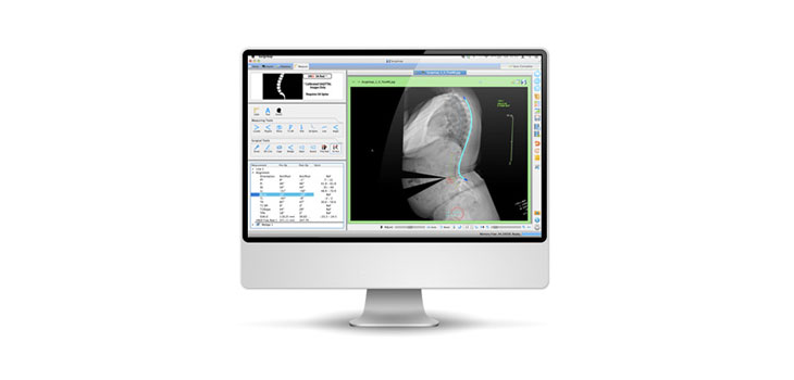 FDA Clears Spine Surgery Software