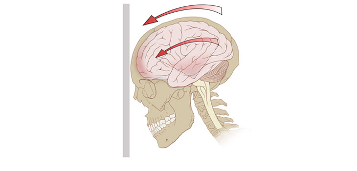 Concussions Continue to Haunt NFL