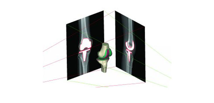 1st Materialise Guided Knee Surgery Announced