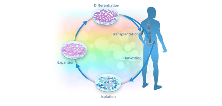 Stem Cells in ALS Clinical Trial