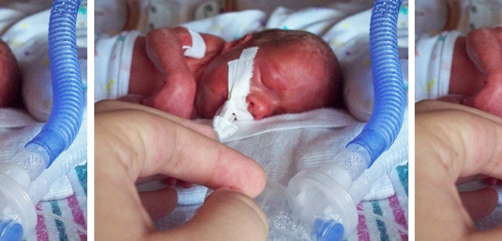 Moms With RA More Likely to Have Premature Babies