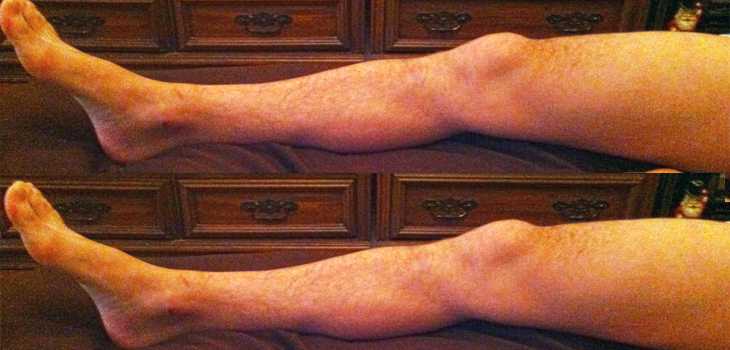 Paralyzed Man Regains Feeling in Legs