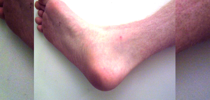 World First 3-D Printed Titanium Heel Implanted