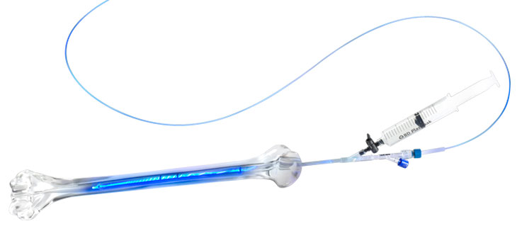 IlluminOss: Conditional FDA Approval for Bone Stabilization System