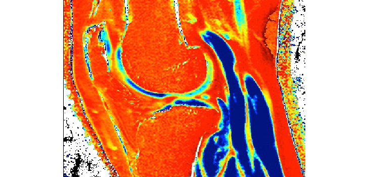 $1.04 Million to University of Texas for Cartilage Regeneration