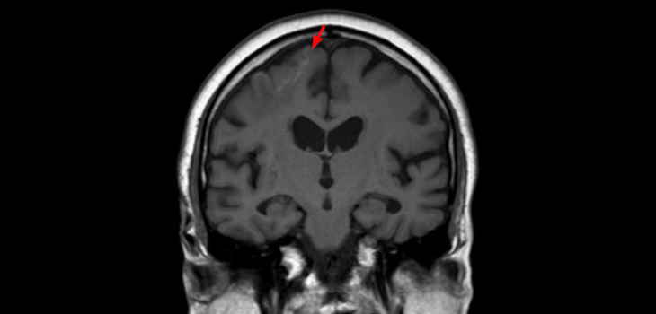 Arthritis Drugs Causing Strokes, Death?