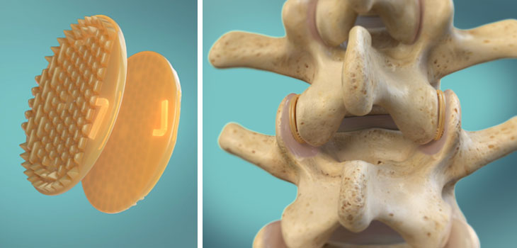 Zyga’s Facet Restoration Study Has First Patient