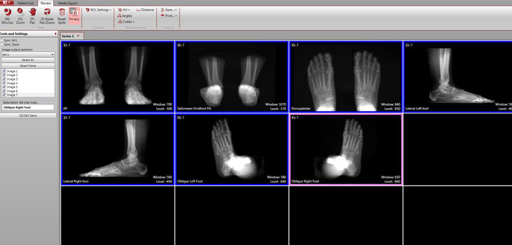 CurveBeam: Eliminating Plain X-rays for Foot, Ankle
