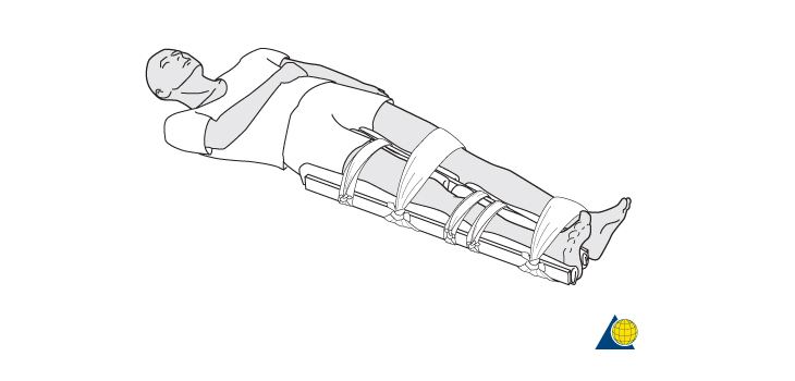 Doc Crusades to Correct Poor Splinting