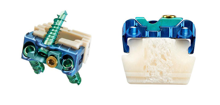 A First With Zimmer Cervical Plate Clearance