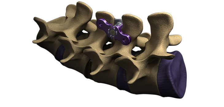 Aurora Spine Device Invades Israel