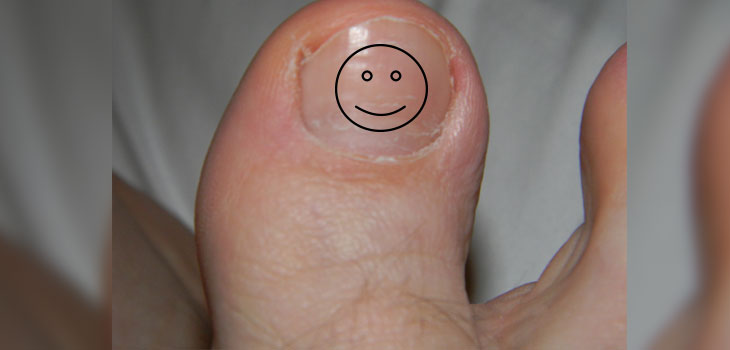 Big Toe Clinical Trial Nears Completion