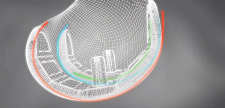 Colorado Surgeon Implants 3-D Printed Knees