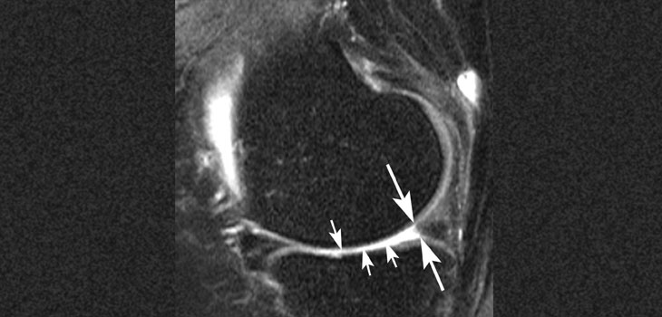 Meniscal Surgery Increasing Risk of OA, Cartilage Loss?